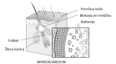 Mikrokomedon je prva stopnja razvoja akne