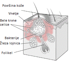 Sestava Pustula (mozolj)