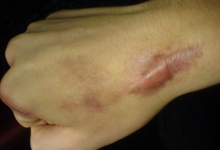 Brazgotina - keloid