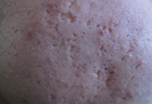 Luknjičaste brazgotine po aknah na licih