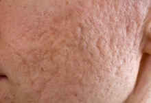 Valovite brazgotine od aken