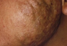 Hipertrofična brazgotina