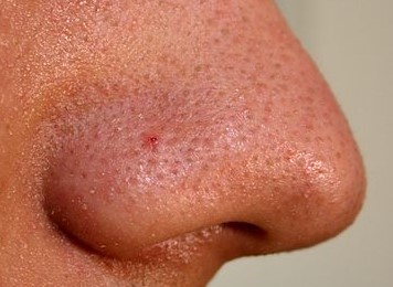 Nos z nekoliko širšimi porami in črnimi ogrci. Z rednim čiščenjem kože in por lahko tak videz učinkovito izboljšamo