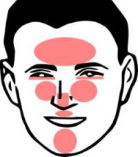 Rozacea: Deli obraza, kjer se izražajo simptomi in znaki