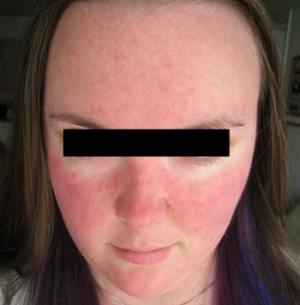 Rozacea tip 1 - najzgodnejši znak bolezni, rdečica obraza