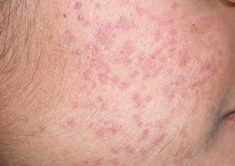 Rdeči, roza madeži od mozoljev, aken