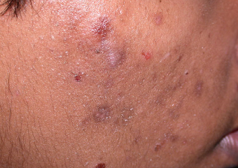 Rjavi temni madeži od mozoljev - hiperpigmentacija