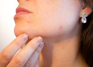 Ženska z mozolji na bradi