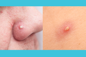 mozolj na nosu in koži