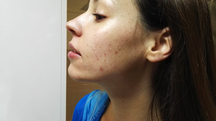 Prej / Potem: Kako učinkovito prekriti mozolje z ličili? Sandra svetuje in prikaže