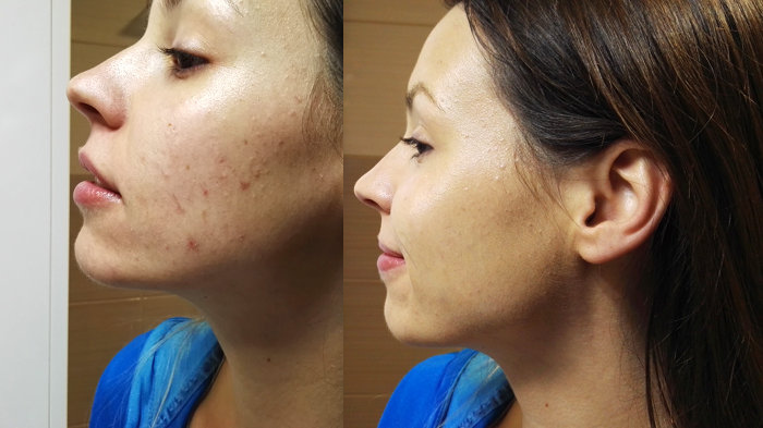 Izgled kože po prekrivanju aken s korektorjem in pudrom