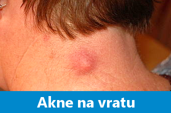 Mozolji na vratu - epidermalna cista