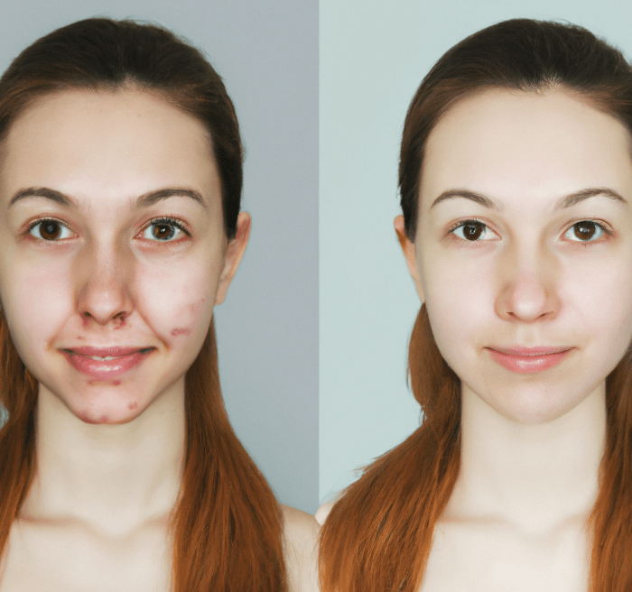 ženski obraz prej potem po kemičnem pilingu z AHA kislino