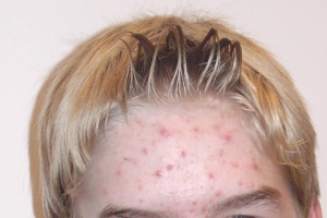 ženska z aknami na čelu